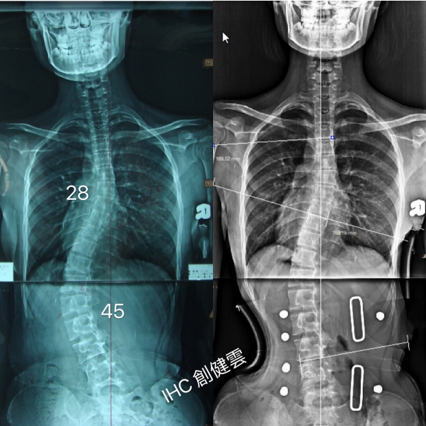 案例12：穿上背架後X光對比.jpg