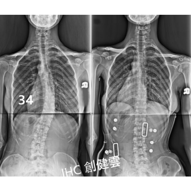 X光對比-34度.png