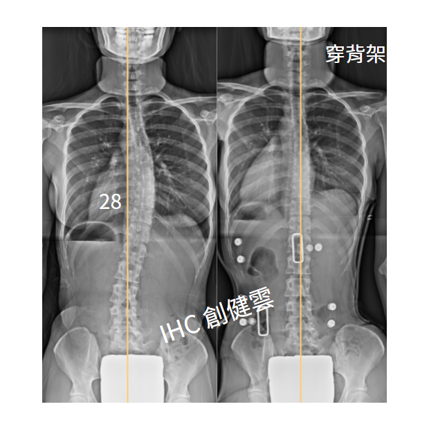 23. X光對比 21歲女生 28度.png