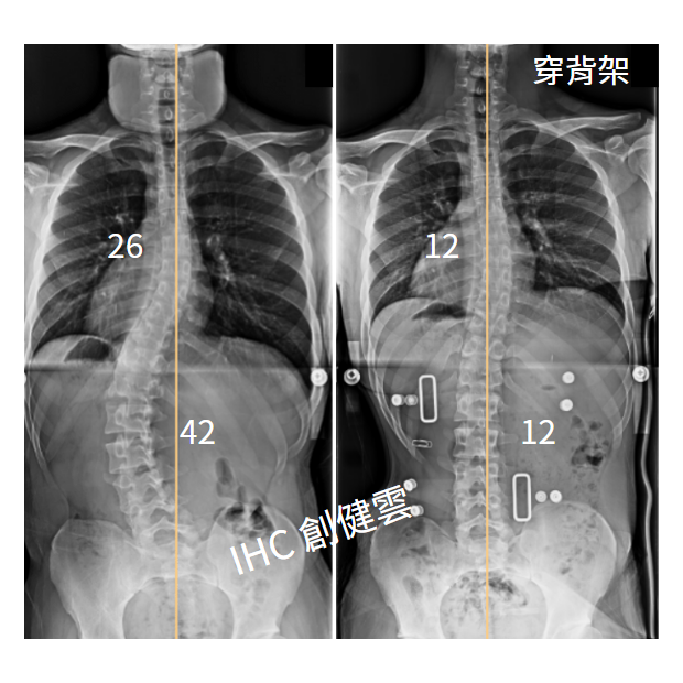 24.X光對比 19歲男生 42度.png