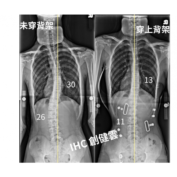 27.X光對比 15歲男生.png