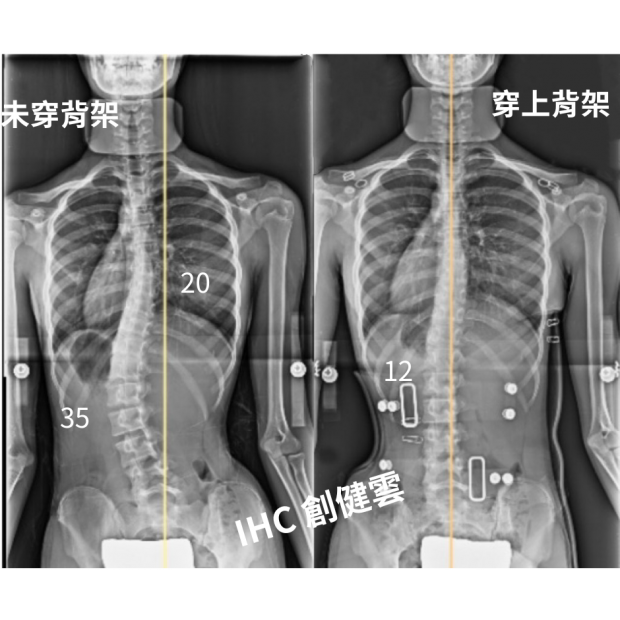 28.X光對比 12歲女孩 35度.png