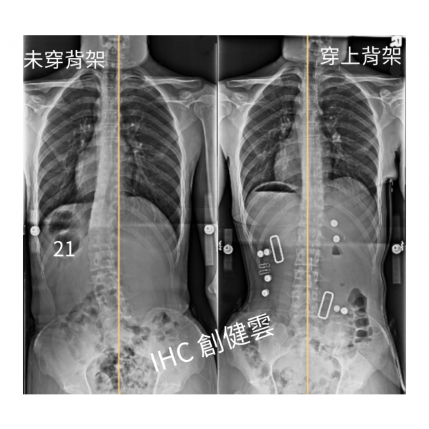 29.X光對比 16歲男生 21度.png