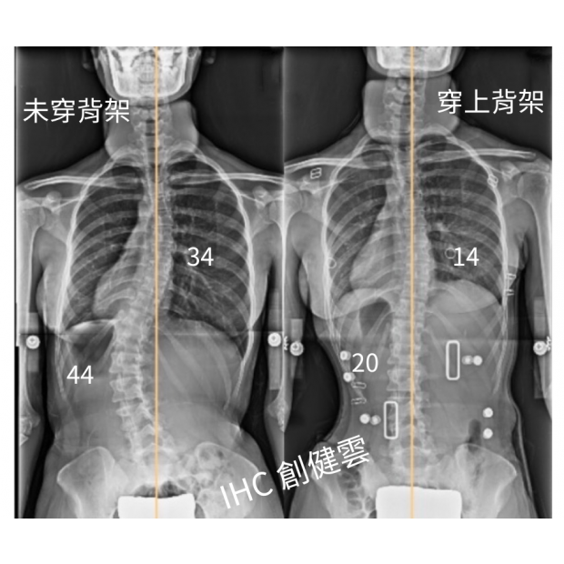 30.X光對比 16歲女生.png