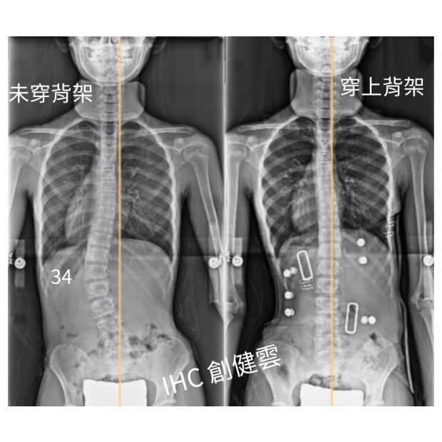 32.X光對比 10歲女生.png