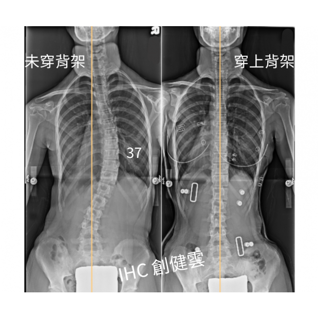34.X光對比 13歲女生.png