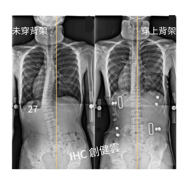 35.X光對比 14歲男生.png