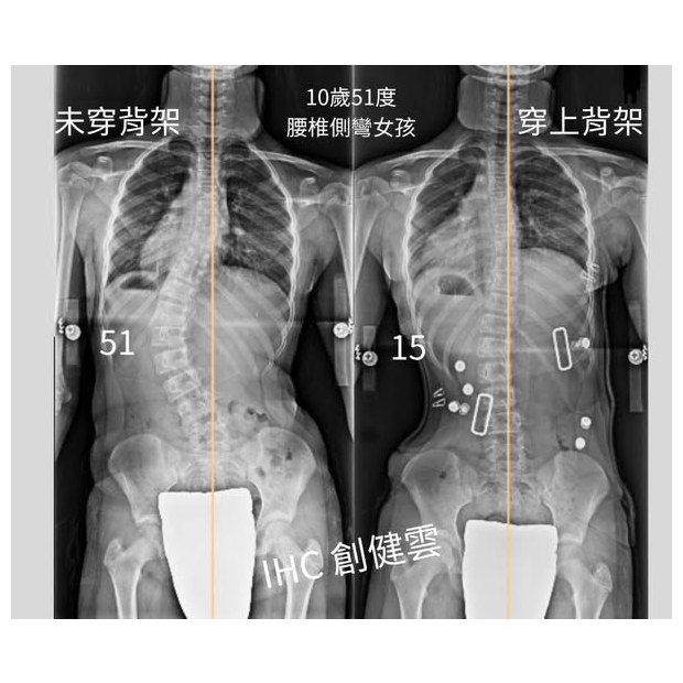 10歲女孩 腰彎51度.jpg