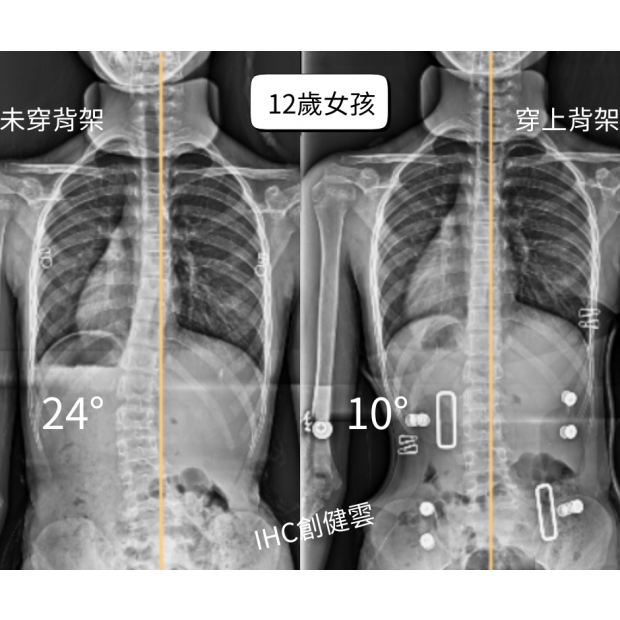 12歲女孩 腰彎24度.png