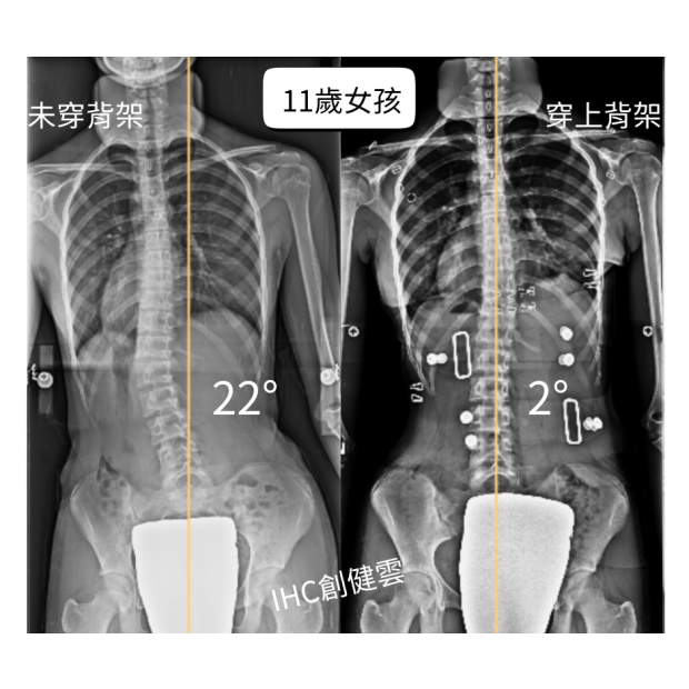11歲女孩 腰彎22度.png