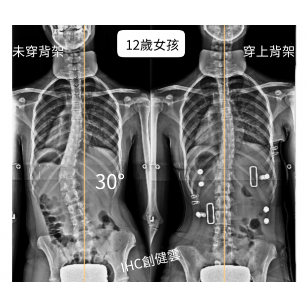 12歲女孩 腰彎30度.png