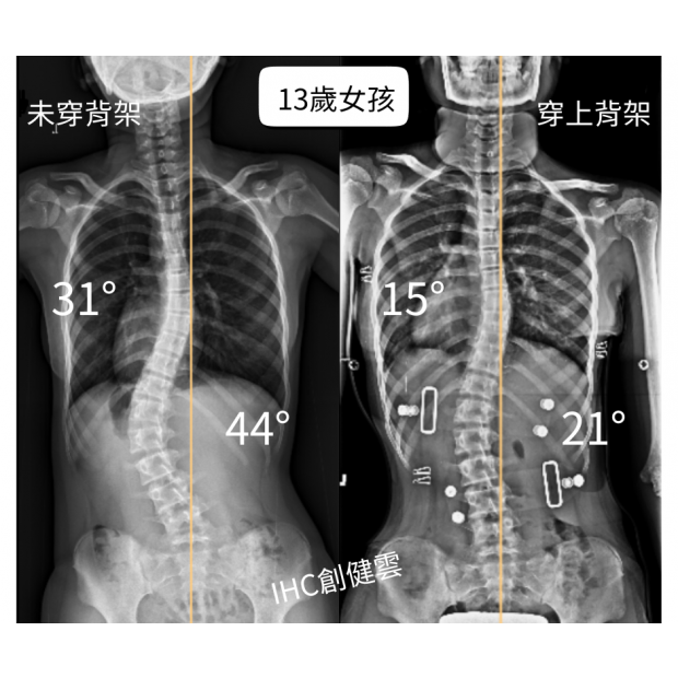 13歲女孩 胸彎31度腰彎44度.png
