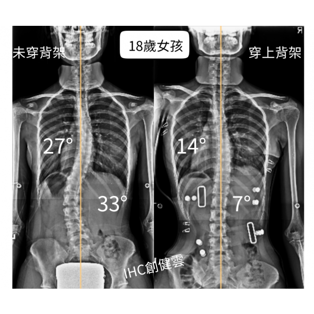 18歲脊椎側彎女孩 胸彎27度 腰彎33度.png
