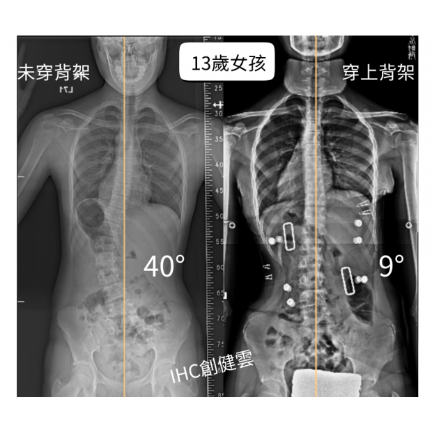 13歲女孩 腰彎40度.png