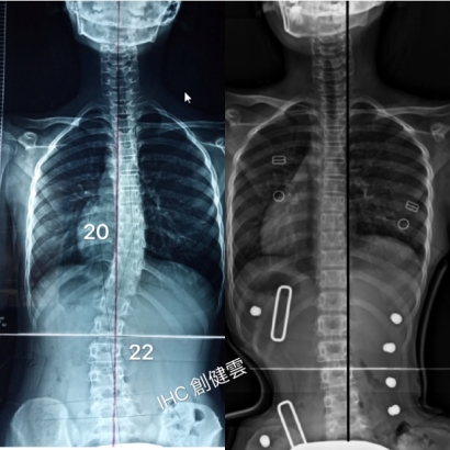 案例8：穿背架X光對比.jpg