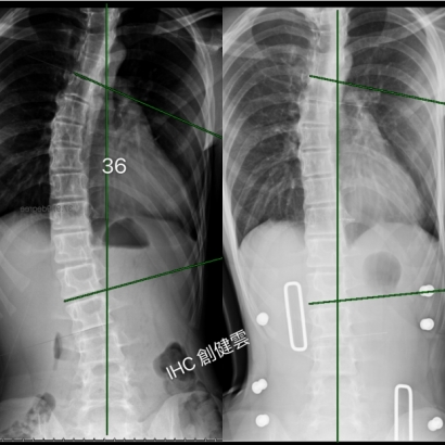 案例10：穿背架X光對比.jpg