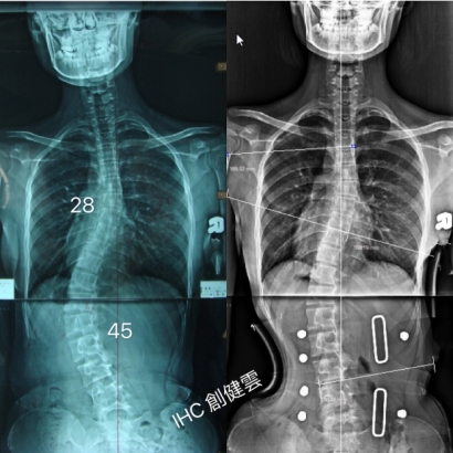 案例12：穿上背架後X光對比.jpg