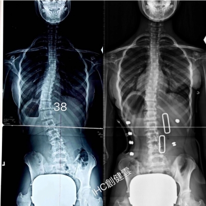 案例2：穿背架X光照片.jpg