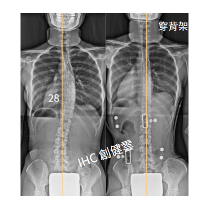 23. X光對比 21歲女生 28度.png