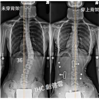 25.X光對比 17歲女生 36度.jpg