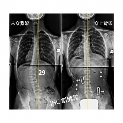 26.X光對比 14歲男生 29度.jpg