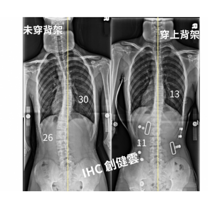 27.X光對比 15歲男生.png