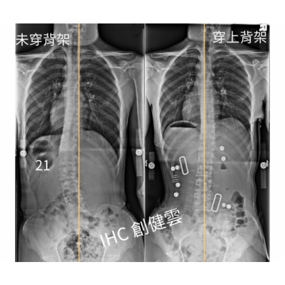 29.X光對比 16歲男生 21度.png