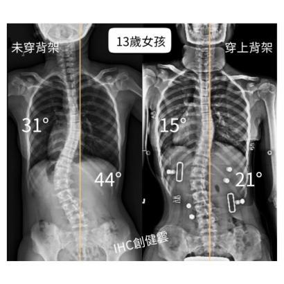 13歲女孩 胸彎31度腰彎44度.png