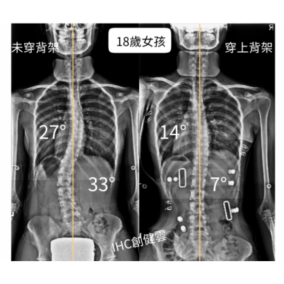 18歲脊椎側彎女孩 胸彎27度 腰彎33度.png 18歲脊椎側彎女孩 胸彎27度 腰彎33度.png
