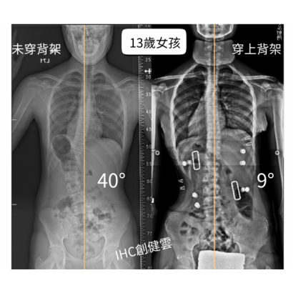 13歲女孩 腰彎40度.png 13歲女孩 腰彎40度.png